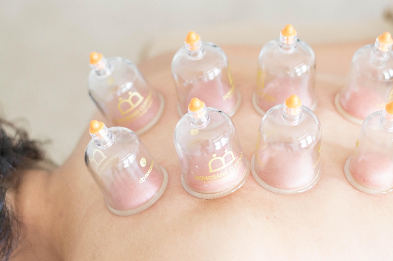 cupping therapy back